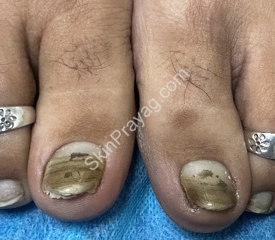 Fungal nail infection treatment