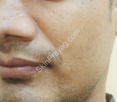 Hyaluronic acid fillers