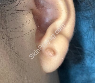 Before ear lobe keloid removal