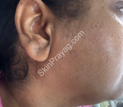 Skin Tag Removal