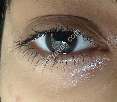After milia removal